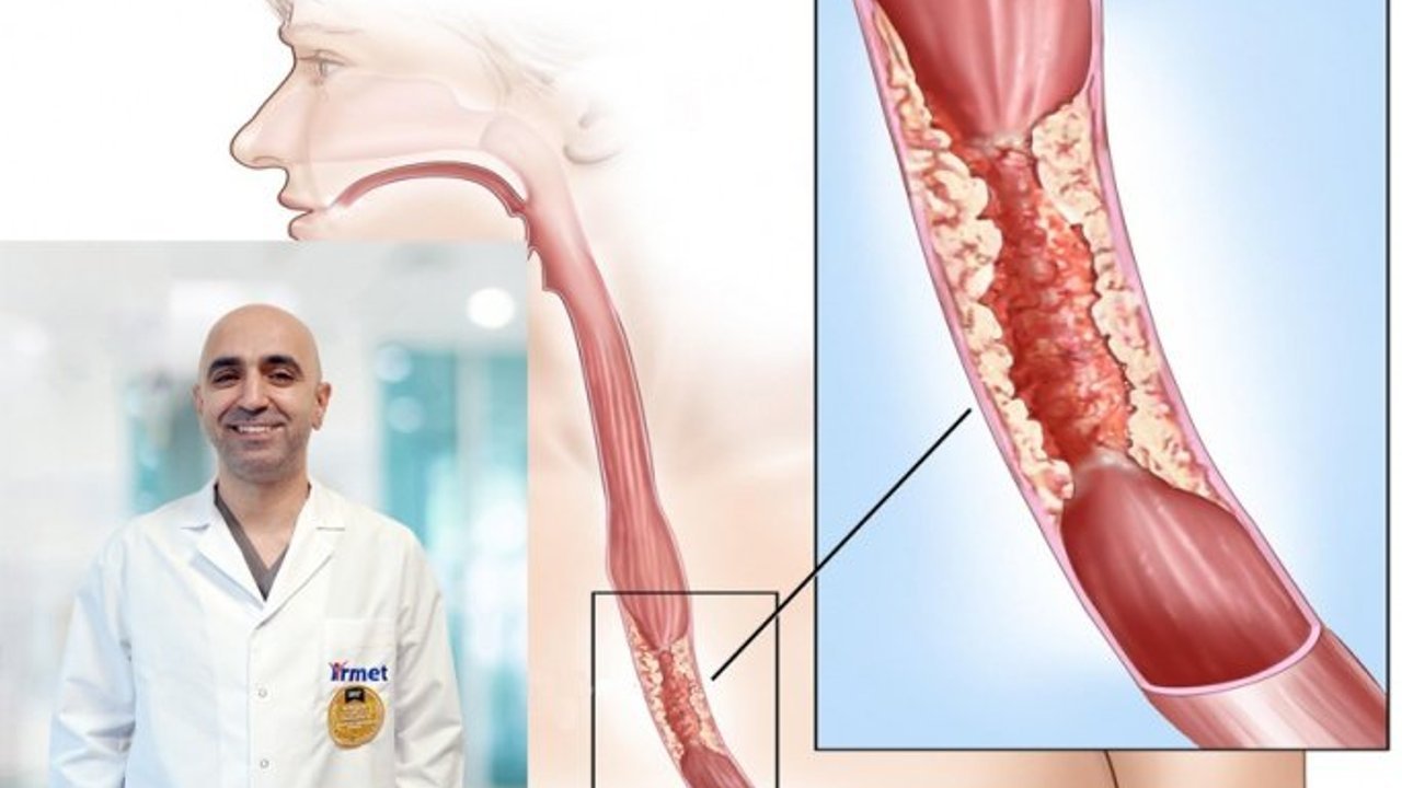 Yemek Borusu Kanseri Tanı ve Tedavi Yöntemleri